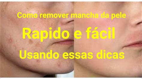 Como Tirar Mancha Do Rosto De Sol - Como tirar mancha do rosto - YouTube