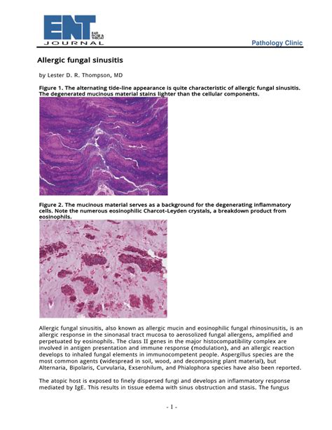 Pdf Allergic Fungal Sinusitis