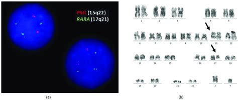 A Fish Analysis Of The Patient The Vysis Probe Set Showed Two