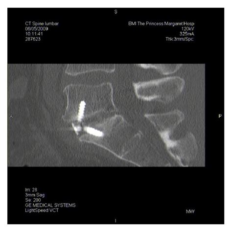 Axial view of bilateral L5 pedicle fracture. | Download Scientific Diagram