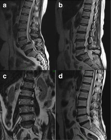 Lumbar Degeneration Diseases The Three Representative Degenerative