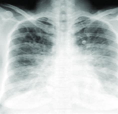 Chest X-ray showing perihilar interstitial infiltrates and an increase ...