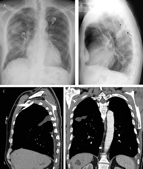 Fluid Around Lung Ct Scan 