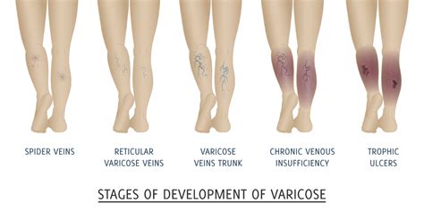 Say Goodbye To Spider Veins With Sclerotherapy St Louis Laser Veins