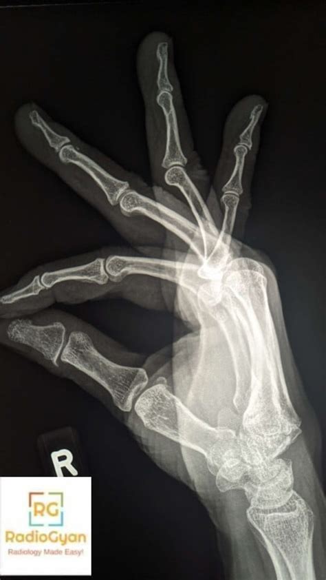 Carpal Boss Radiology Case - RadioGyan