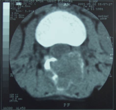 Aneurysmal Bone Cyst - spine - 9yo | BoneTumor.org