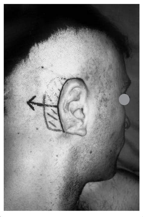 surgical step skin ways   creation   retroauricular