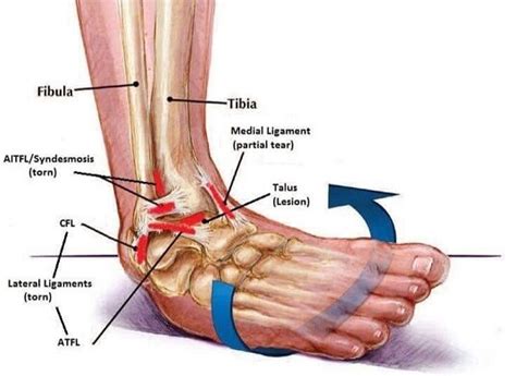 Best Ankle Sprain Treatment in Toronto