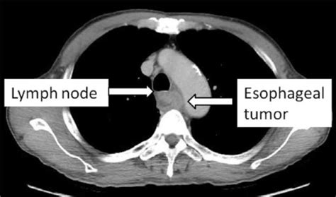 Diagnosis Kanker Esofagus Alomedika