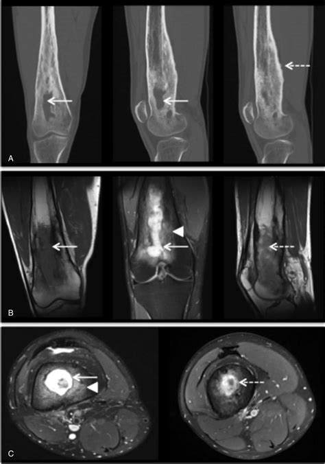 Osteomyelitis With Intraosseous Abcess A Tomodensitometry Of The