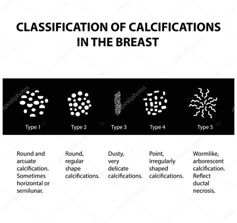 Clasificación De Calcificaciones En La Glándula Mamaria Mamografía La Glándula Mamaria