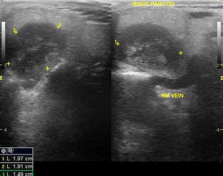 Pleomorphic Adenoma Of The Parotid Gland Radiology Case Radiopaedia Org