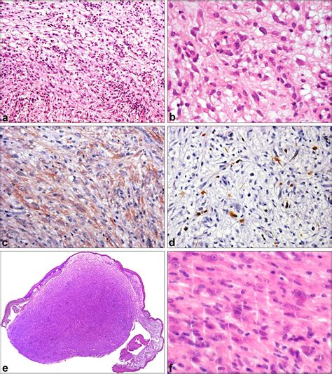 Differential Diagnosis Of Laryngeal Spindle Cell Carcinoma And