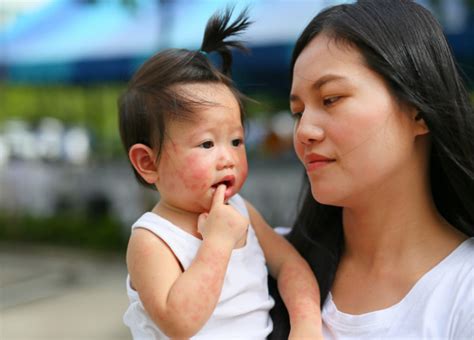 Cara Mengatasi Biang Keringat Pada Bayi Ikuti Langkah Ini Kumparan