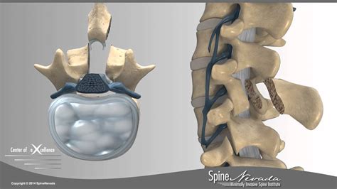 Lumbar Laminectomy In Reno At Spinenevada Northern Nevada Center Of