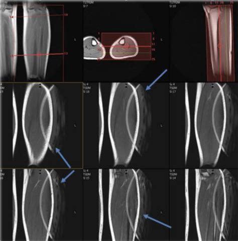 Mriquiz Artifact Imaging Flashcards Quizlet