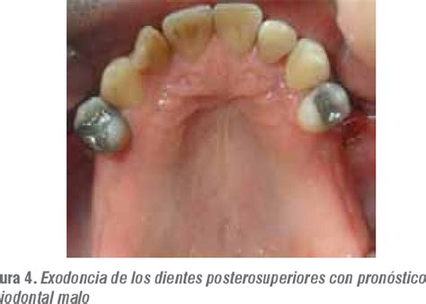 Figure From Tratamiento Cl Nico De Un Paciente Con Periodontitis