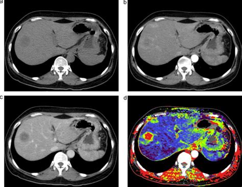 Liver Metastases On Quantitative Color Mapping Of The Arterial