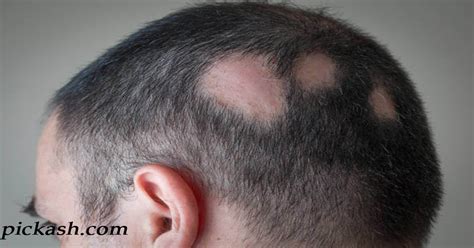 Alopecia Areata: Causes, Symptoms, and Diagnosis