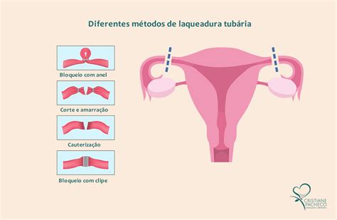 Laqueadura Tub Ria Conhe A A Nova Lei Dra Cristiane Pacheco