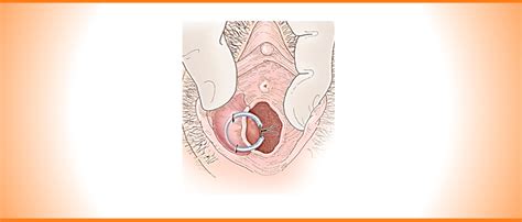 Manejo De Cisto De Bartholin Bartholinite Anel De Jacobi