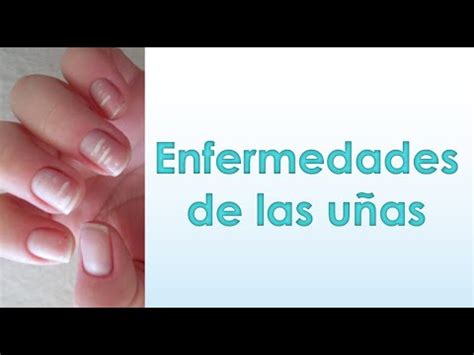 Enfermedades de las uñas Aprende todo sobre ellas YouTube