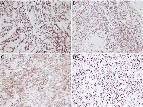 Immunohistochemical Staining Of Tumor Cells Showed Diffuse Positivity