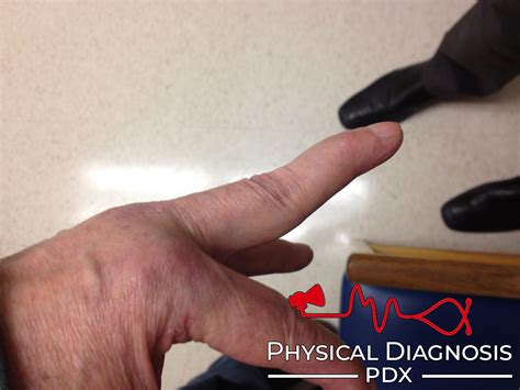 Swan Neck Deformity Physical Diagnosis Pdx