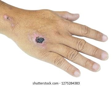 Skin Lesion Crusting 이미지, 스톡 사진 및 벡터 | Shutterstock