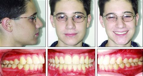 Twin Force Bite Corrector For Class Ii Molar Distalization