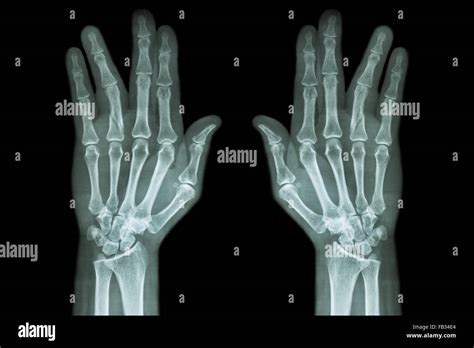 Fracture Shaft Of Proximal Phalange Of Ring Finger Film X Ray Both