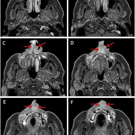 Nasal Tumor At Initial Consultation A Progression Before Therapy