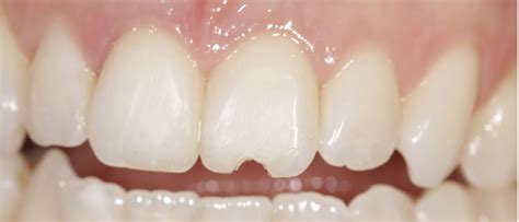 Broken Front Tooth After A Fall