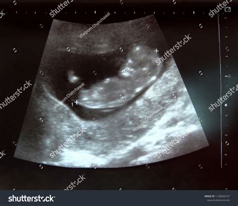 5,847 Ultrasound Human Fetus Images, Stock Photos & Vectors | Shutterstock