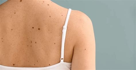 Skin Growths Why Do Moles Warts Skin Tags Milia Appear