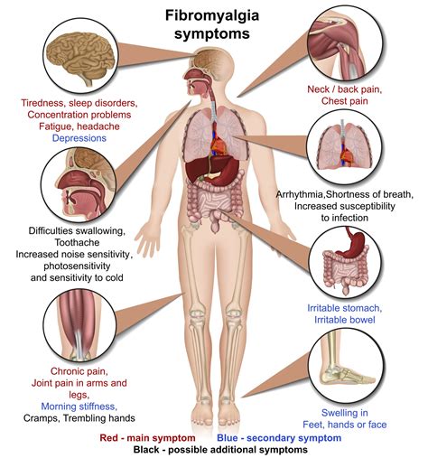 Fibromyalgia Outline Health Osteopath Farnham Osteopath Odiham