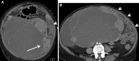 Borderline Mucinous Tumor Post Contrast Axial Ct Images Of The Pelvis