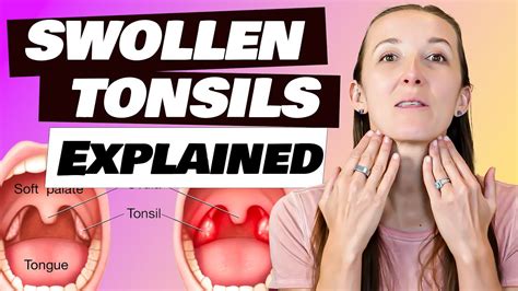 What Are The Causes Of Swollen Tonsils Why Removal Is Not Always The First Option Youtube