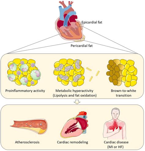 Epicardial Adipose Tissue An Emerging Biomarker Of Cardiovascular