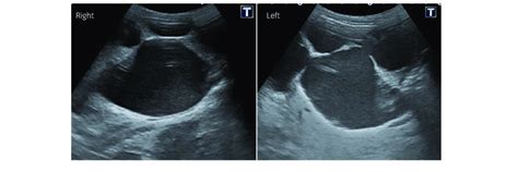 Intraoperative Ultrasonography Showing Severe Right And Left Dilatation