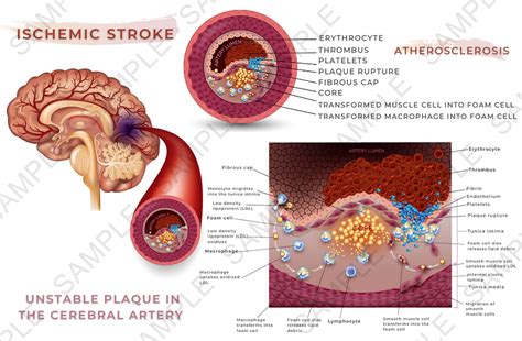 Ischemic Stroke (printable) | Miss Medicine