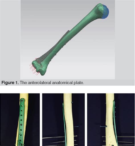 Figure 1 From A NEW ANATOMICAL PLATE FOR EXTRA ARTICULAR DISTAL HUMERAL