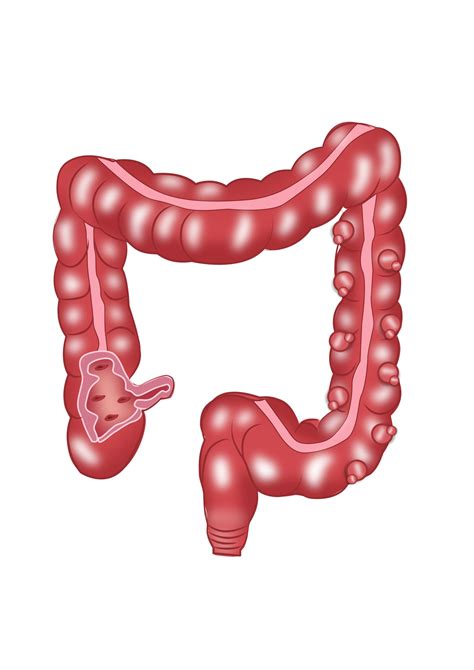 Diverticular Disease And Other Colitis Surgical Health Specialists