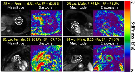 Sex Differences In Aging Related Myocardial Stiffening Quantitatively Measured With Mr