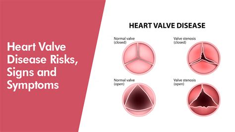 Heart Valve Disease Symptoms