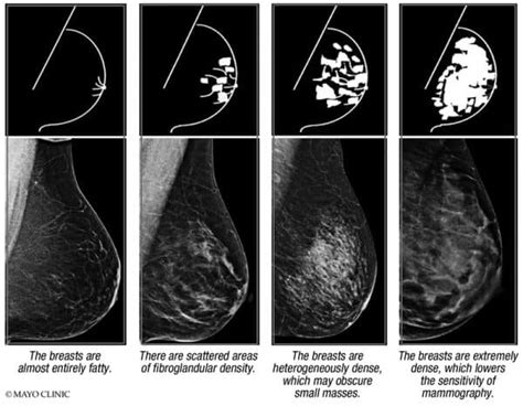 What Does It Mean If I Have Dense Breasts Mayo Clinic Press