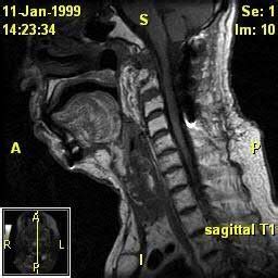 (a) MRI of the soft tissues of the neck and cervical spine. Patient 3... | Download Scientific ...