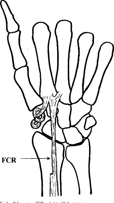 Figure 2 from First Carpometacarpal Joint Arthritis | Semantic Scholar