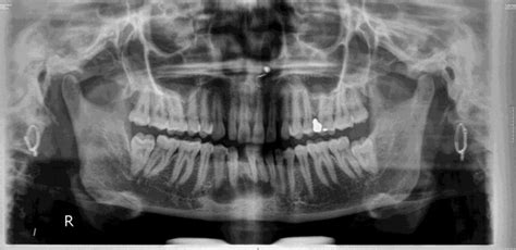 Traumatic Bone Cyst Or Solitary Bone Cyst Bmj Case Reports