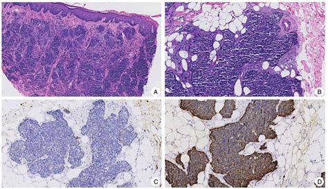 Cutaneous Metastasis Of Uterine Cervical Carcinoma With A Cellulitis